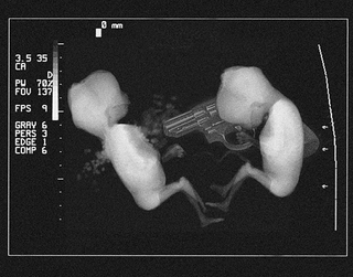 An Albuquerque Police Department ultrasound depicting the fetal fatality.